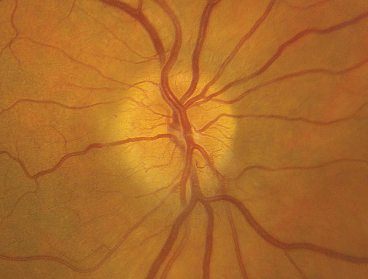 assessing-the-optic-nerve